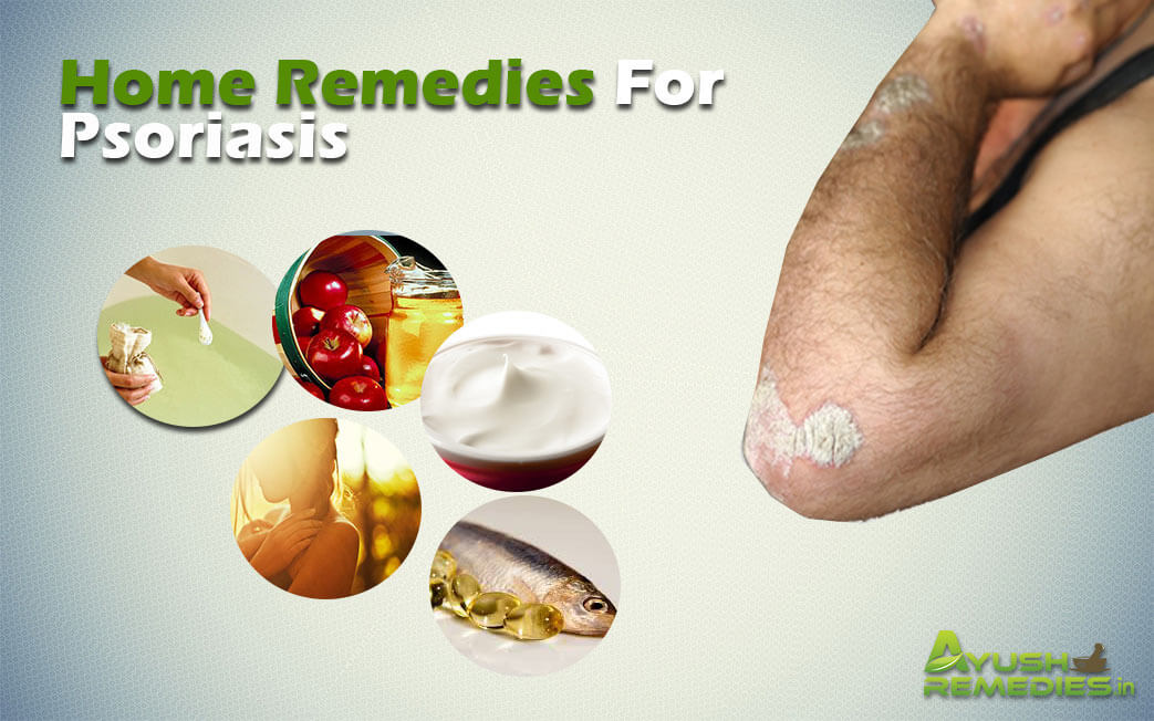 Home Remedies for Psoriasis