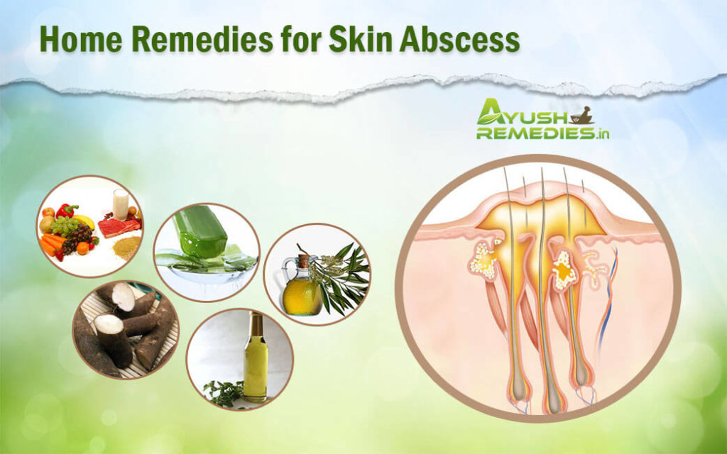 Home Remedies for Skin Abscess