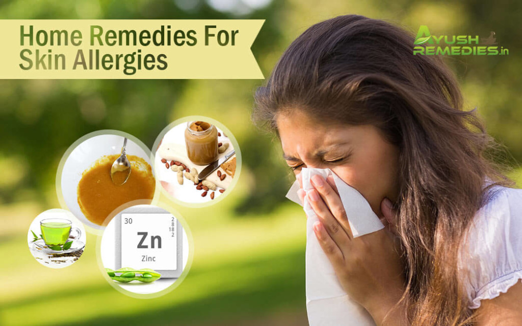 Home Remedies for Skin Allergies