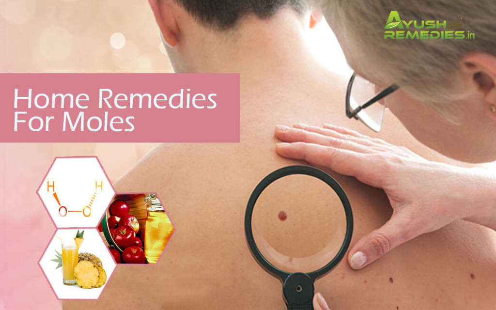 Home Remedies for Moles