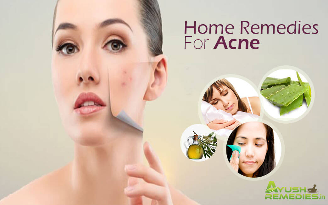 Best Home Remedies For Acne