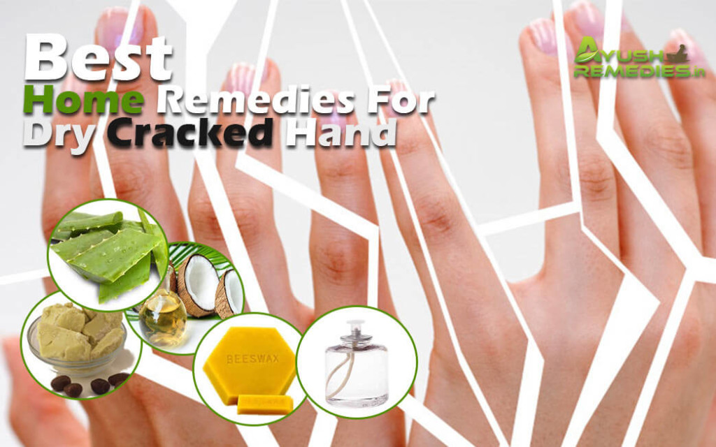 Home Remedies for Dry Cracked Hands