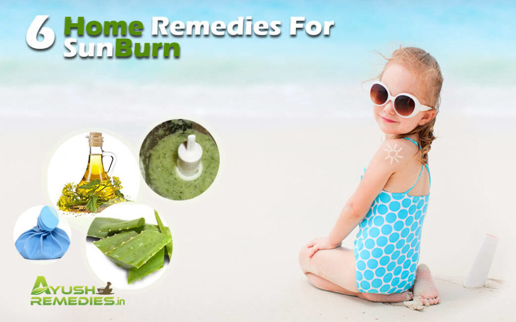 Home Remedies for Sunburn