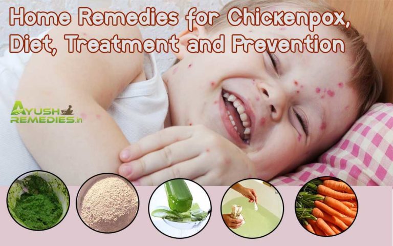 Home Remedies for Chickenpox, Diet, Treatment and Prevention