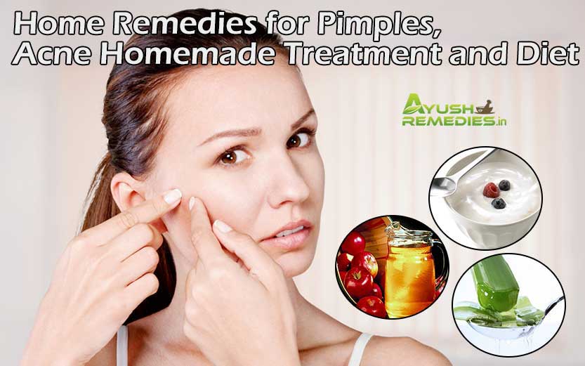 Home Remedies for Pimples