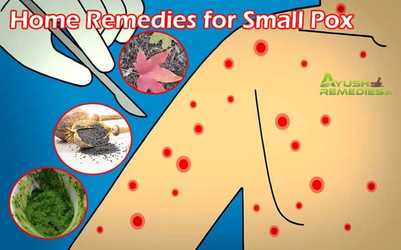 Home Remedies for Smallpox, Diet, Treatment and Prevention