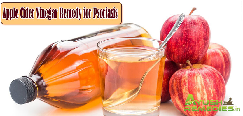 Apple Cider Vinegar Remedies for Psoriasis