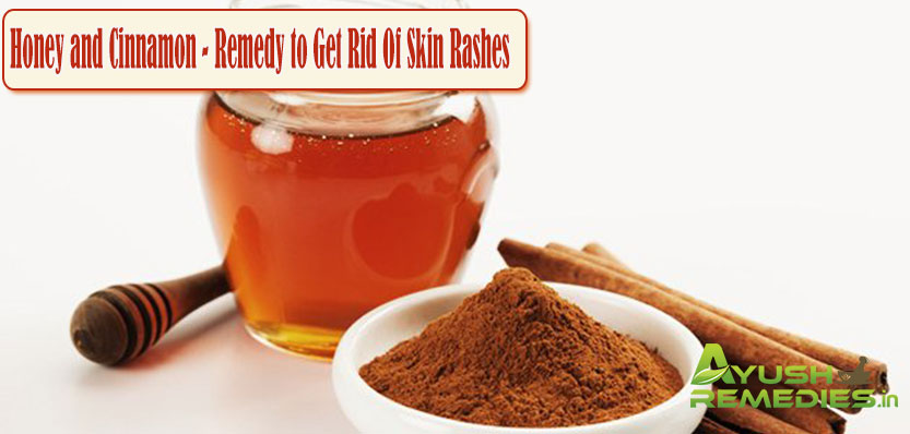 Honey and Cinnamon Remedy to Get Rid of Skin Rashes