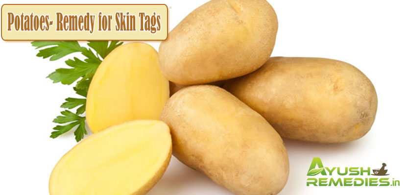 Potatoes Remedy for Skin Tags