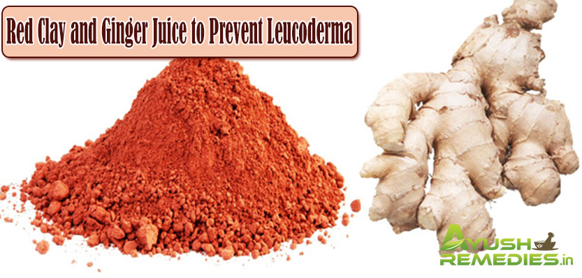 Red Clay and Ginger Juice to Prevent Leucoderma-