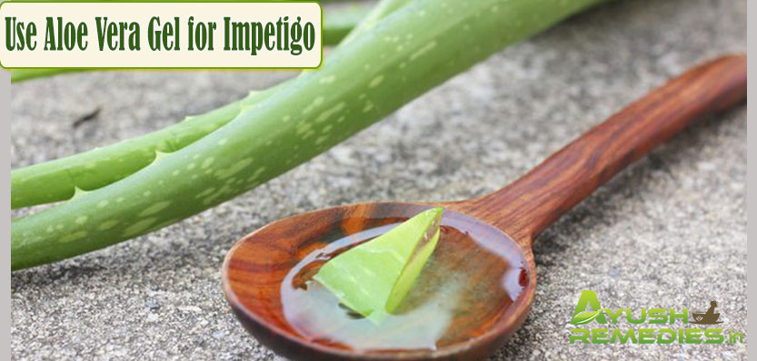 Use Aloe Vera Gel for Impetigo