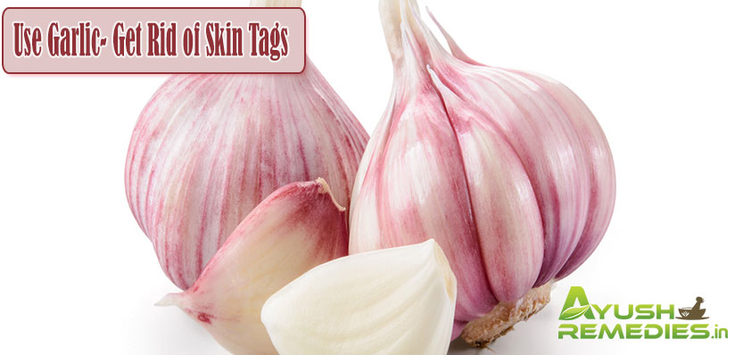 Use Garlic Get Rid of Skin Tags