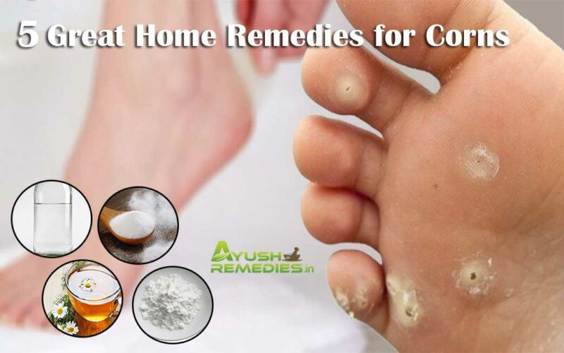 5 Home Remedies for Corns on Feet, Toes, Hands and Fingers