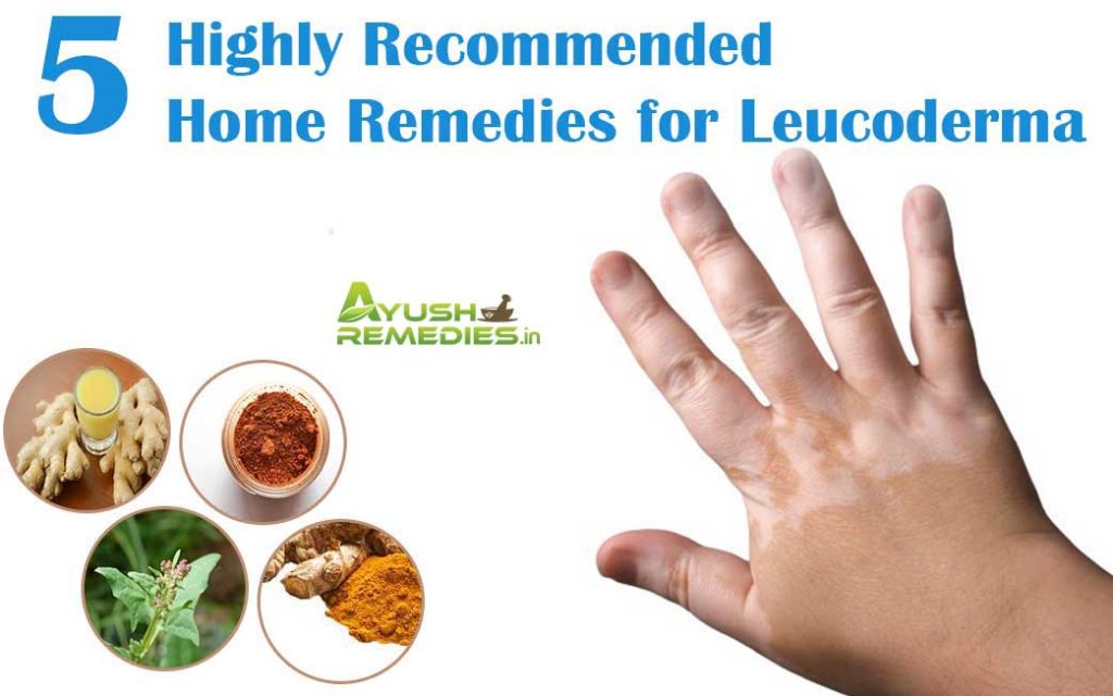 Home Remedies for Leucoderma