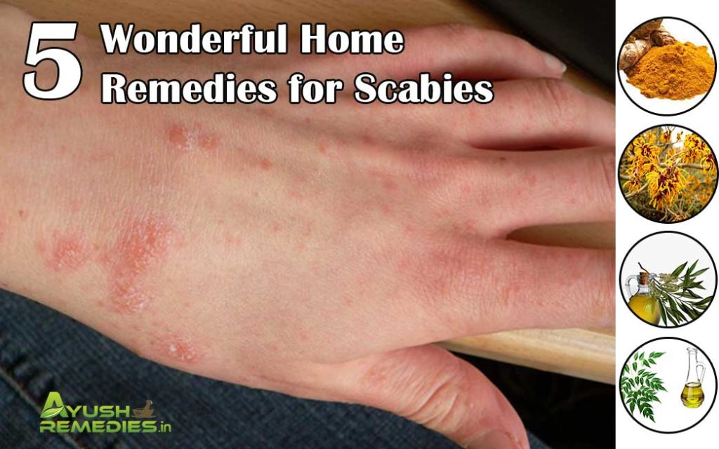 Home Remedies for Scabies