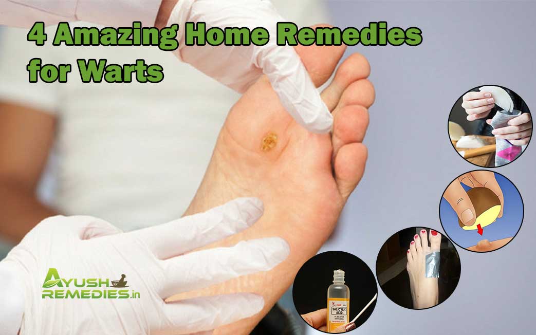 Home Remedies for Warts