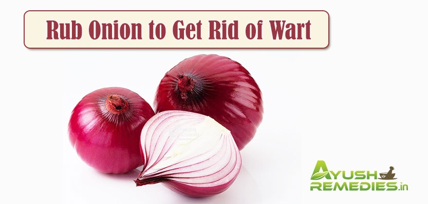 Wart Removal Remedies