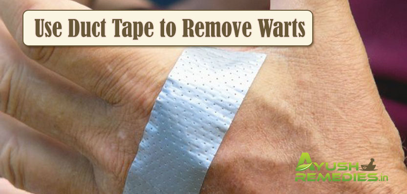 Home Remedies to Remove Warts