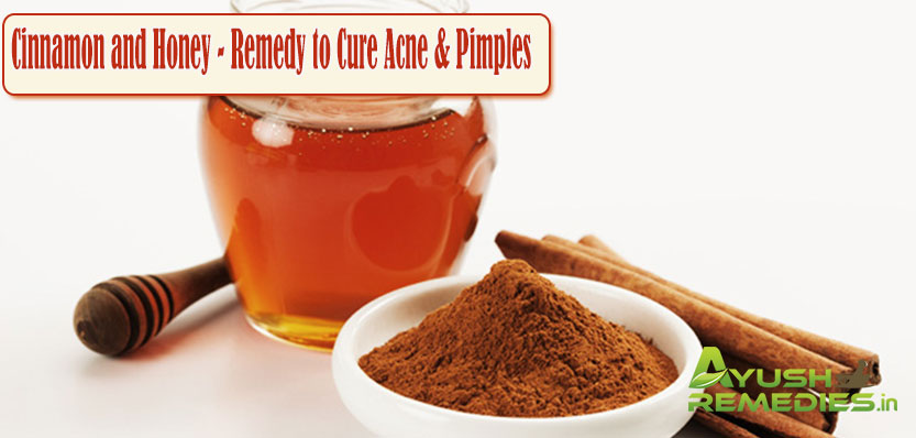 Cinnamon and Honey Remedy to Cure Acne and Pimples