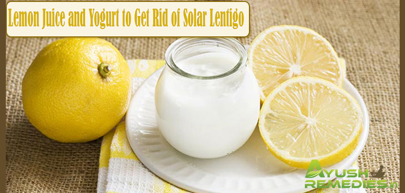 Lemon Juice and Yogurt to Get Rid of Solar Lentigo