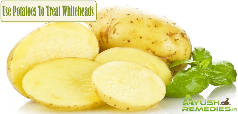 Use Potatoes To Treat Whiteheads