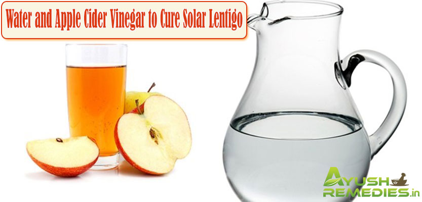 Water and Apple Cider Vinegar to Cure Solar Lentigo