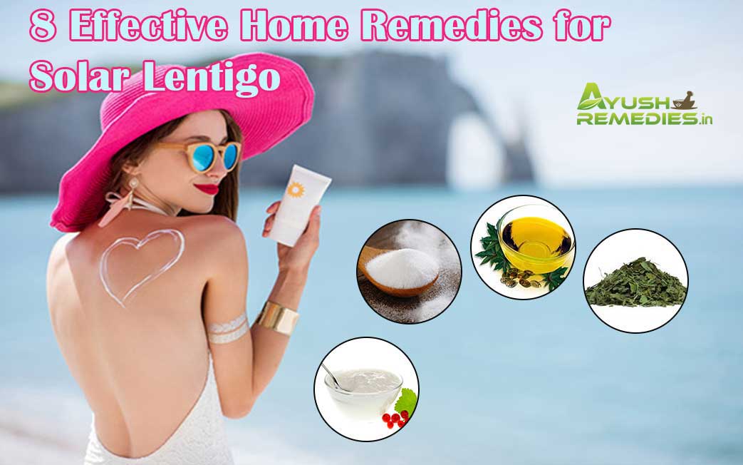 Home Remedies for Solar Lentigo