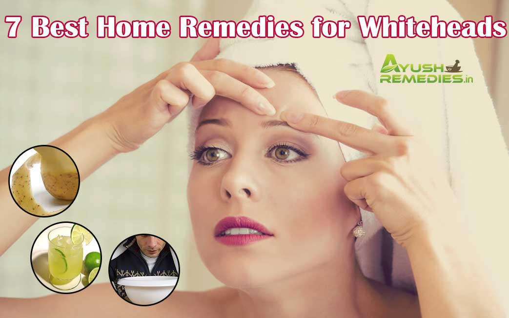 Home Remedies for Whiteheads on Face