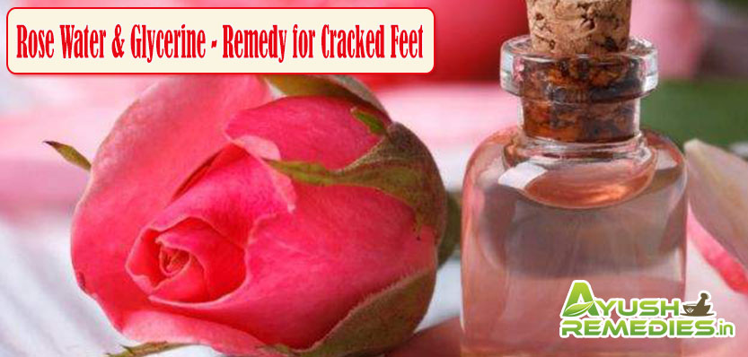 Rose Water and Glycerine Remedy for Cracked Feet